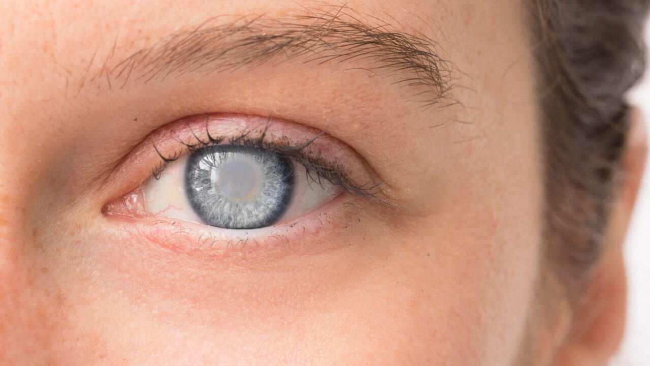 Eye of young girl with corneal opacity